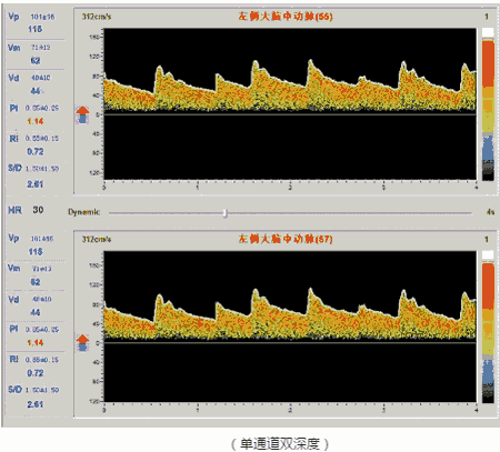 单通道四深度双探头多普勒厂家直销