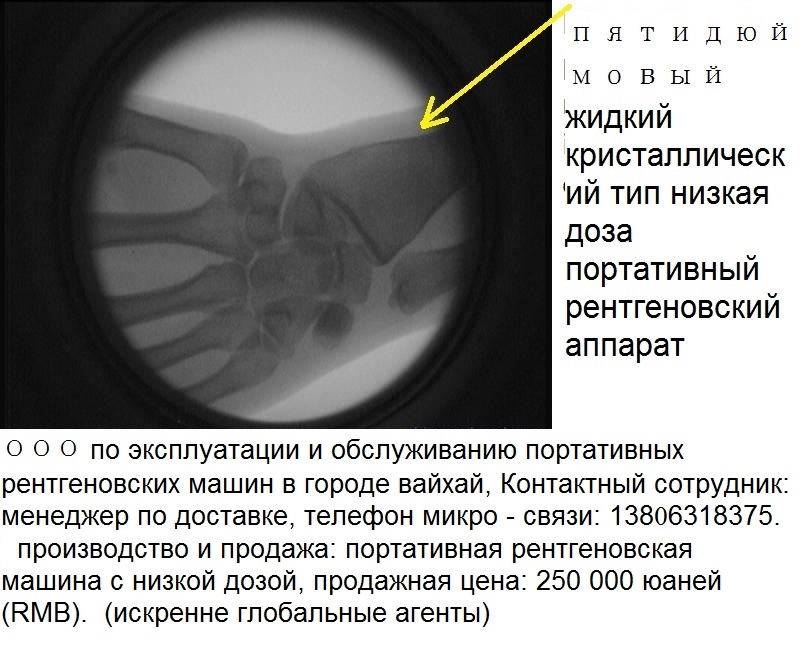 портативный рентгеновский аппарат